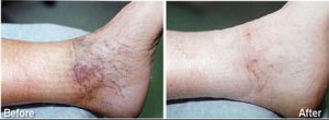 Foam Sclerotherapy Spider veins before and after foam sclerotherapy