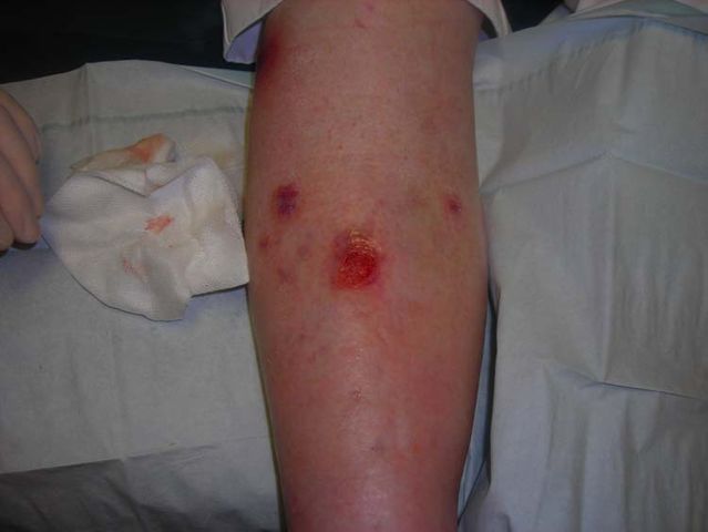 639px-Venous_ulcer_dorsal_leg