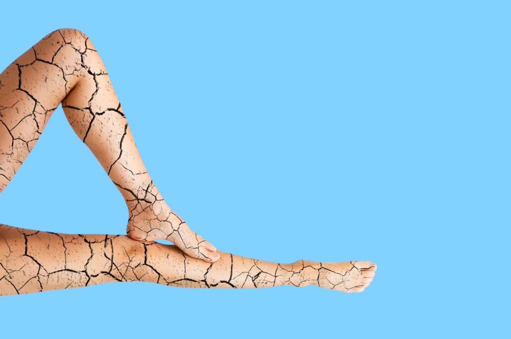 Sclerotherapy for Spider Veins Everything You Need to Know Before Making a Decision St Louis