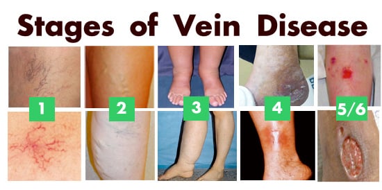 stages of vein disease (2)