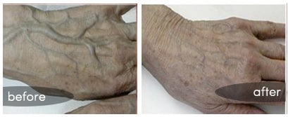 hand vein treatment (1)