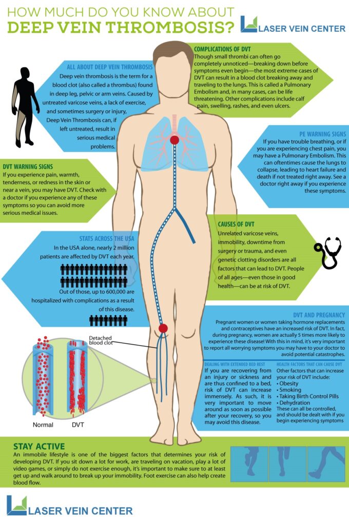 DVT