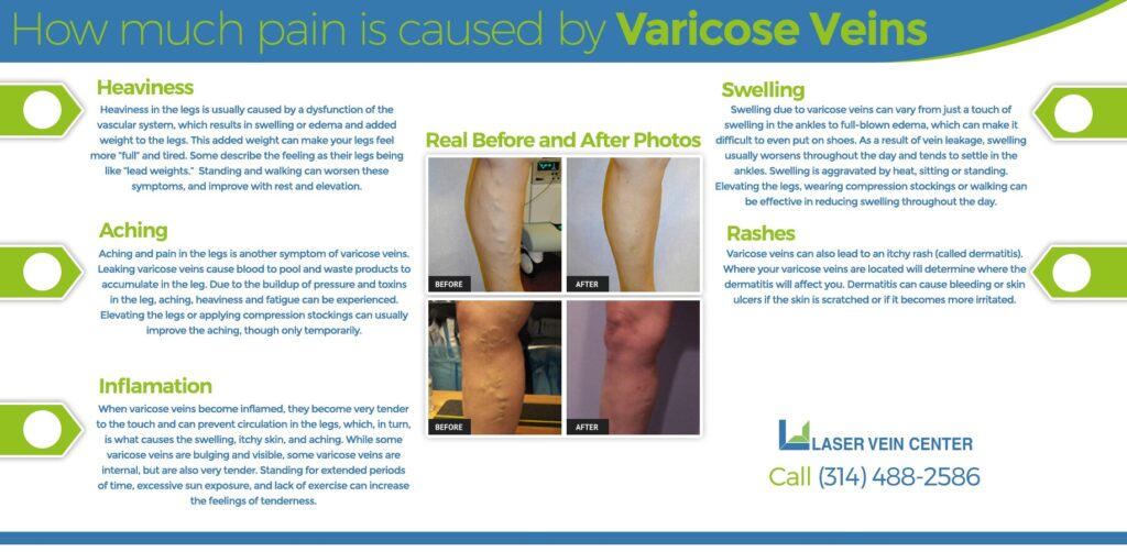 SLLV Varicose Veins Pain