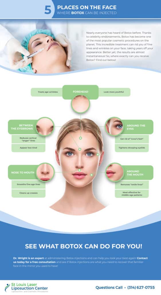 5 Places on the Face Where Botox Can Be Injected SLLLC scaled