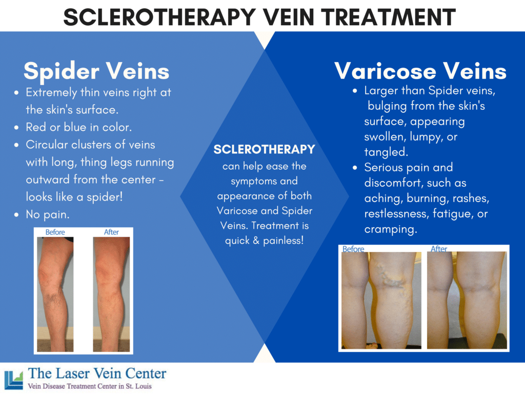 SCLEROTHERAPY FOR SPIDER VEINS