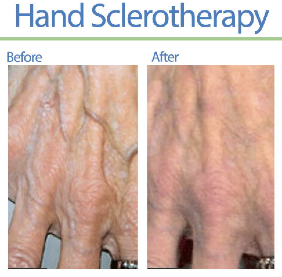 Sclerotherapy on Hand Before After