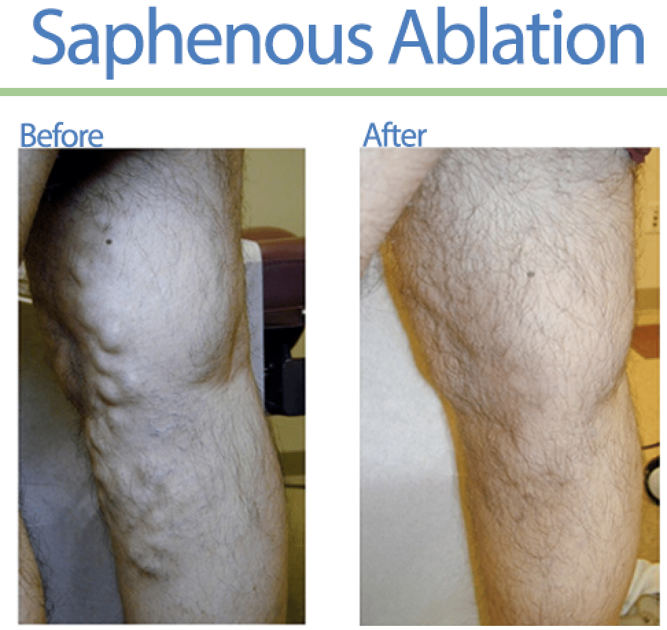 Sclerotherpay Varicose Veins Before After Legs