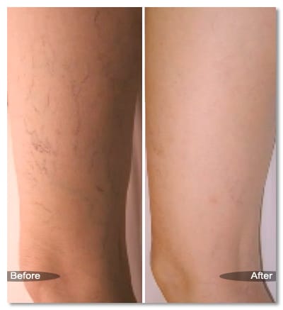 sclero upper leg before after 1
