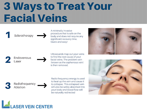 3 Ways to Treat Your Facial Veins