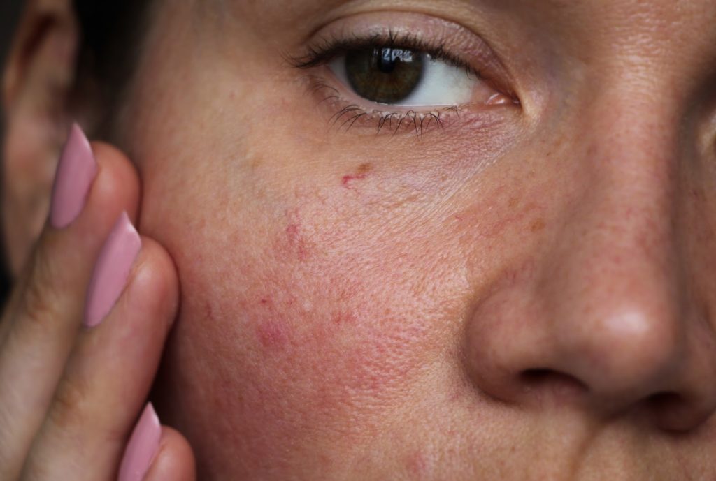 St Louis Laser Vein Treatment 1024x689
