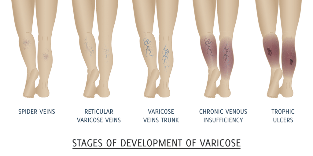 stages of varicose vein st louis 1024x512