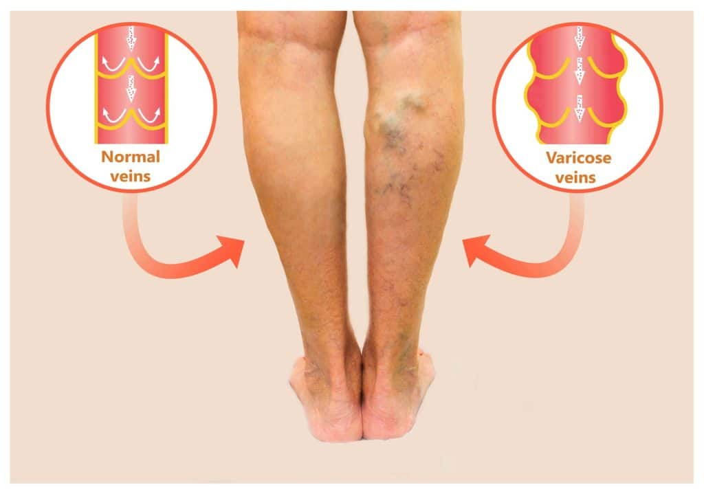 Varicose veins on a female senior legs. Phlebology