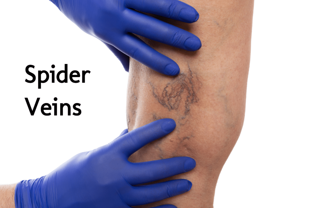 Spider Veins Example St Louis Vein Treatment 1024x682 (1)