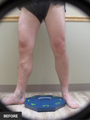 leg-veins-before-after-2-b