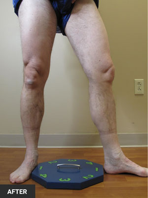leg-veins-before-after-a