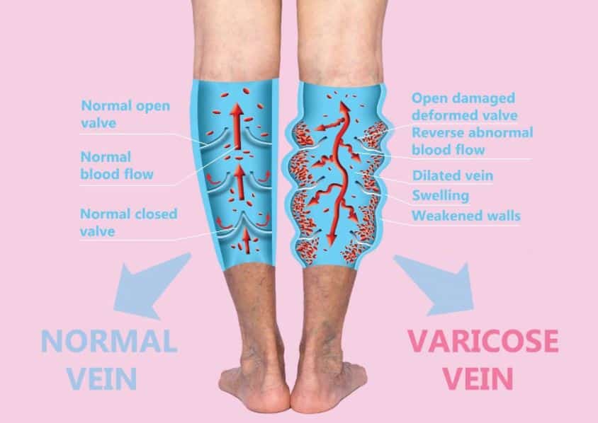 IPL for Spider Veins