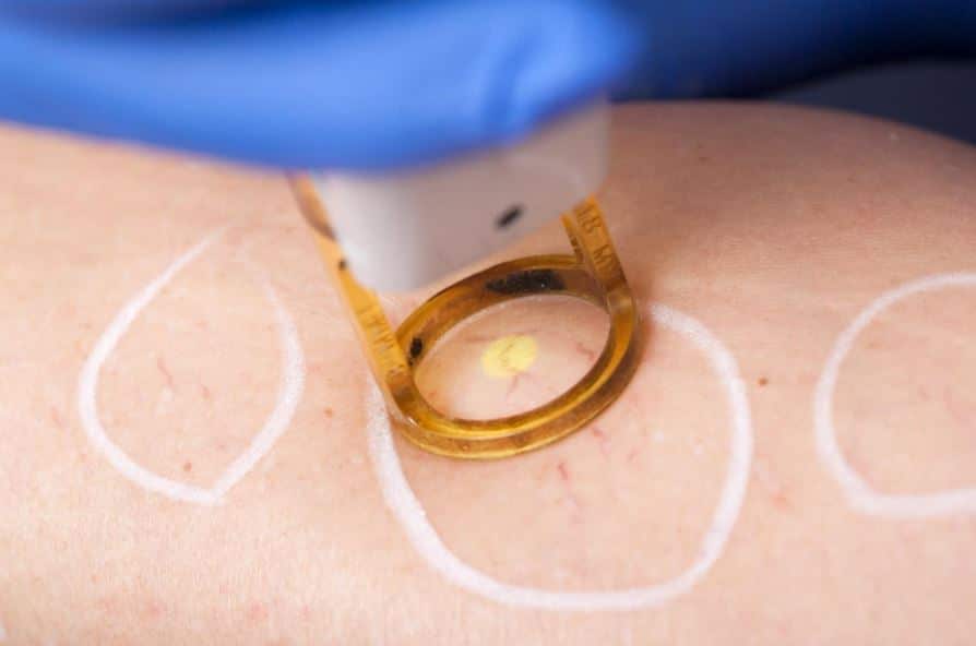 IPL for spider veins example
