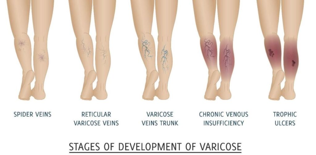 Stages of Varicose 1024x502