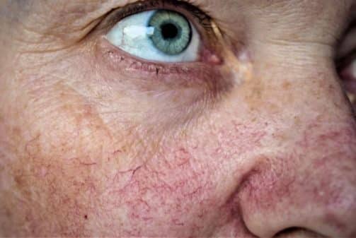 Spider Facial Veins e1635795108299