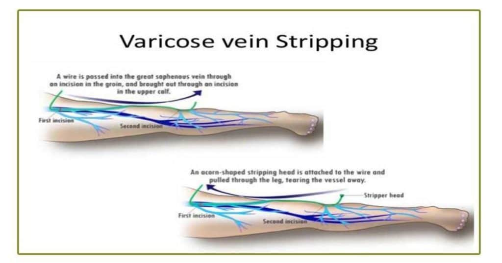 vein stripping 1024x538