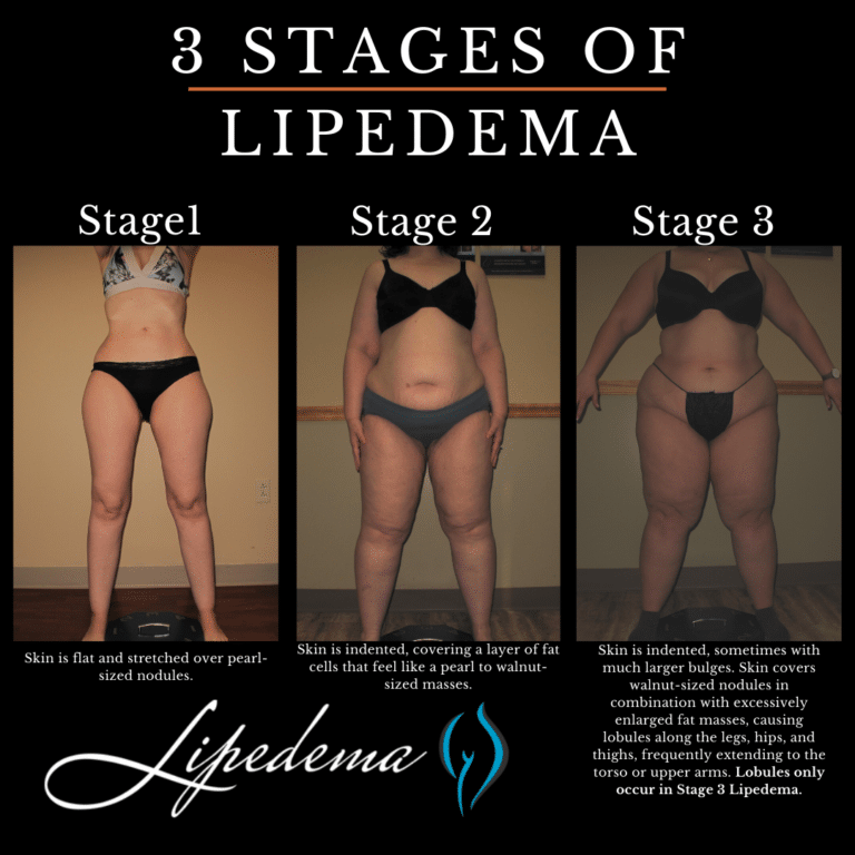 3 Stages of Lipedema 1 768x768