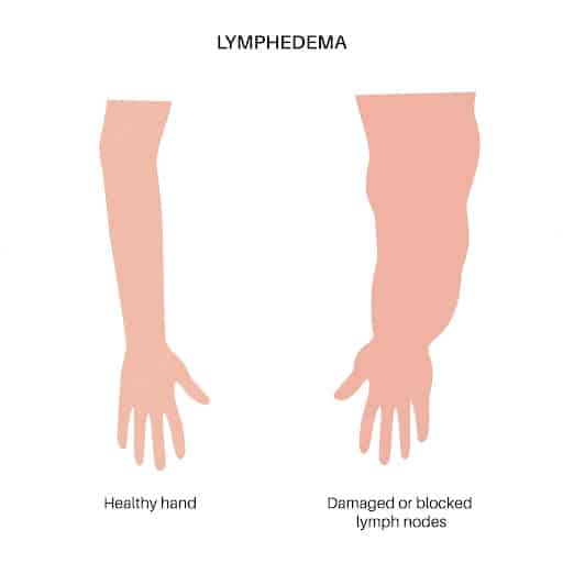 Lymphedema interstital fluid st louis laser lipo