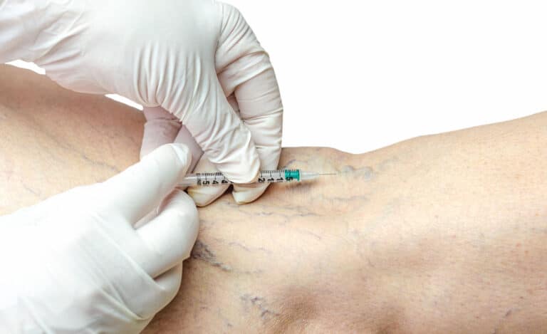 Needles Vein Treatment 768x469
