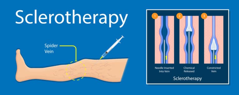 Sclerotherapy graphics st louis laser veins dr wright 768x308