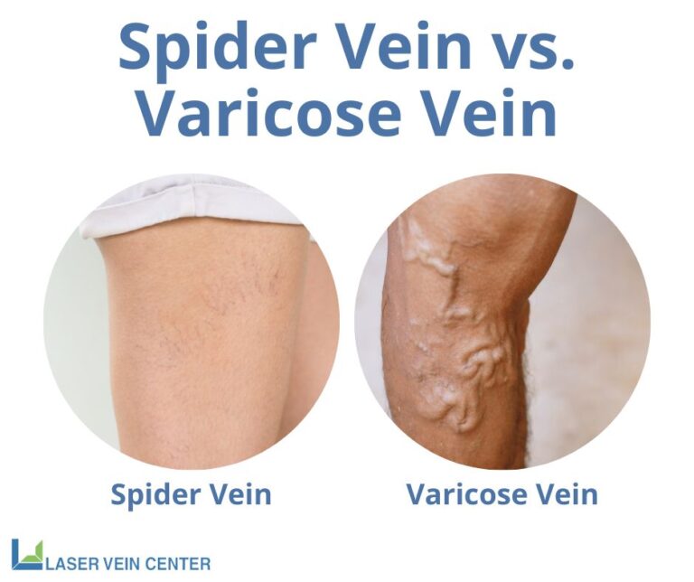 St louis vein treatment spider vein vs varicose vein 768x644
