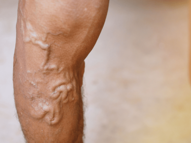 Varicose Veins legs 768x577