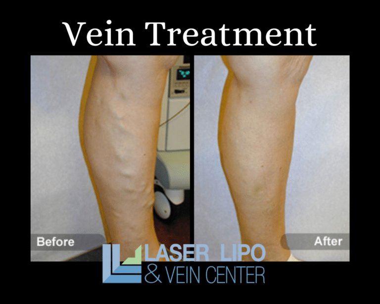 Vein Treatment Before and After St Louis Dr Wright 1 768x614 (1)
