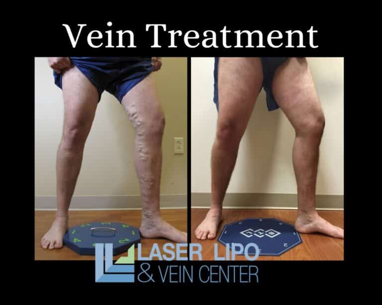 Vein Treatment Before and After St Louis Dr Wright 768x614
