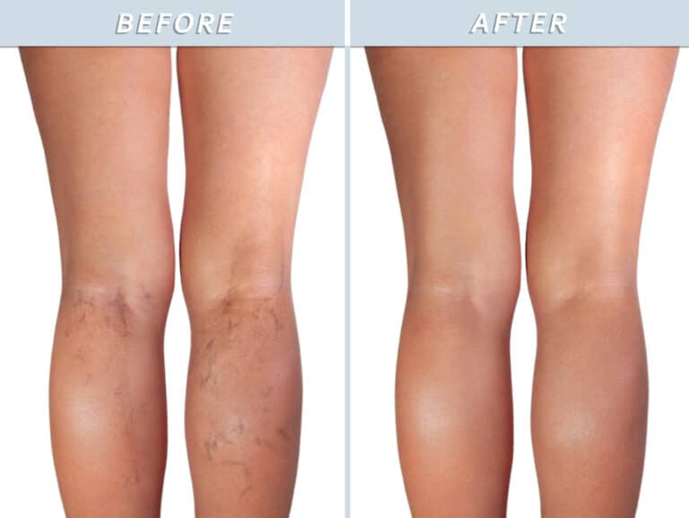 spider vein treatment st louis2 768x577