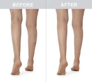 spider vein treatment st louis3 (1) spider vein treatment st louis3 (1)