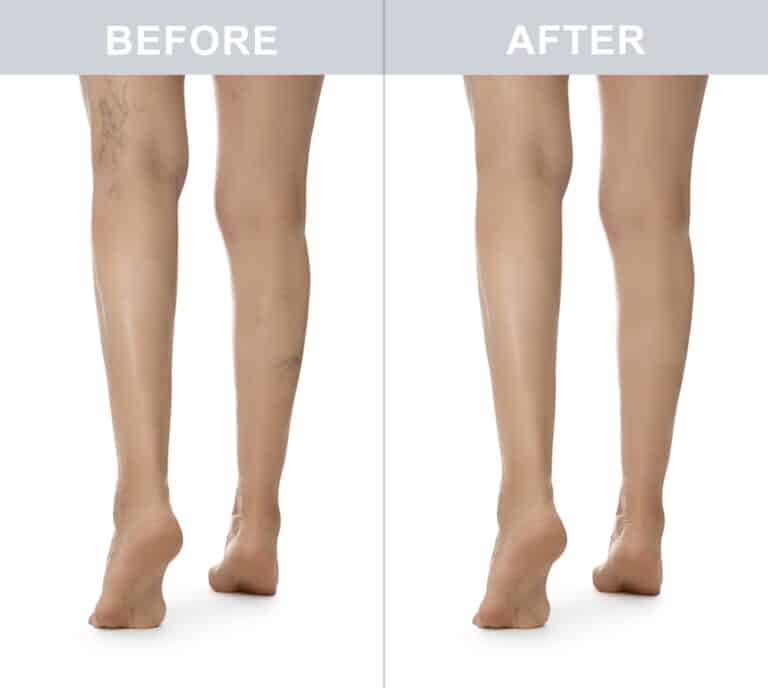 spider vein treatment st louis3 768x688