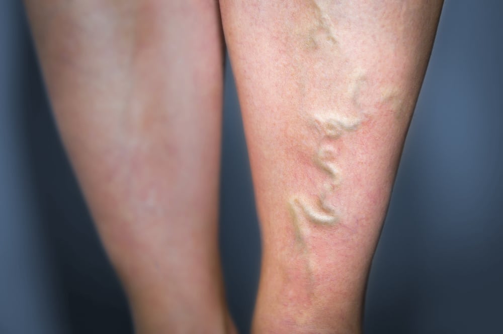 Thrombophlebitis,In,Human,Leg.,Painful,Inflammation,Of,The,Leg,Veins.