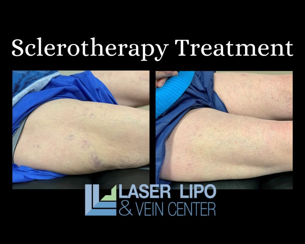 Sclerotherapy Treatment St. Louis Laser Lipo and Vein 1024x819