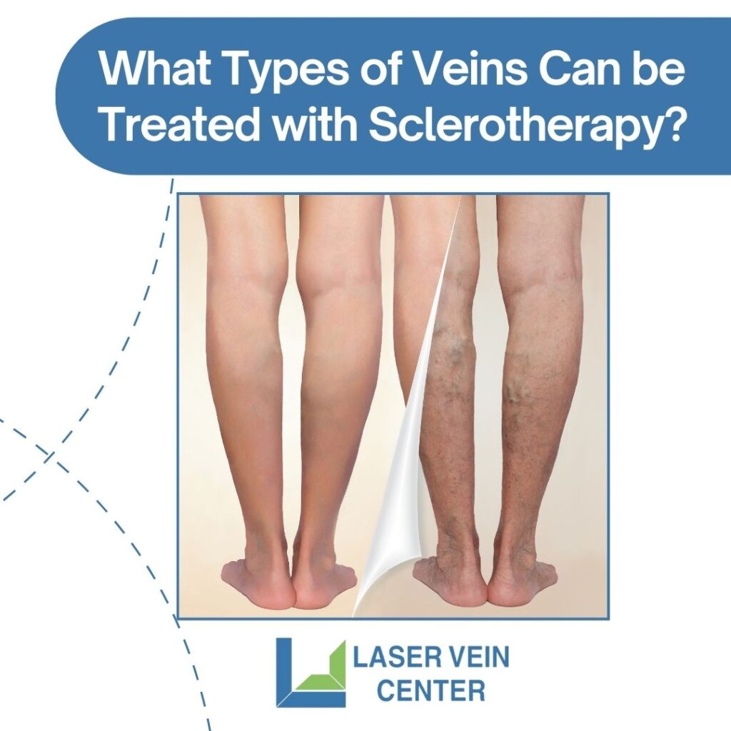 February SLLV What Types of Veins Can be Treated with Sclerotherapy 1024x1024