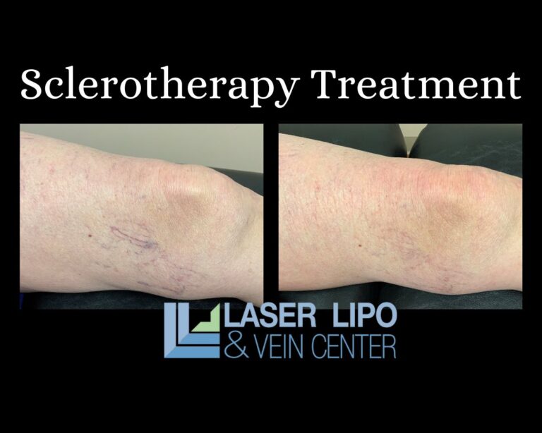 Sclerotherapy Treatment St. Louis Laser Lipo and Vein 2 768x614 (1)