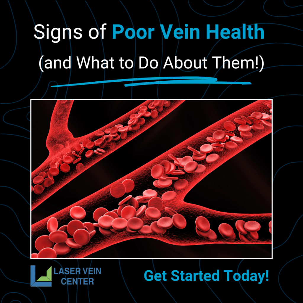 Signs of Poor Vein Health and What to Do About Them 1024x1024