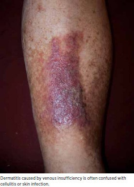 Dermatitis caused by venous insufficiency (1)