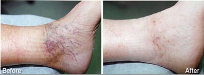 Foam Sclerotherapy1