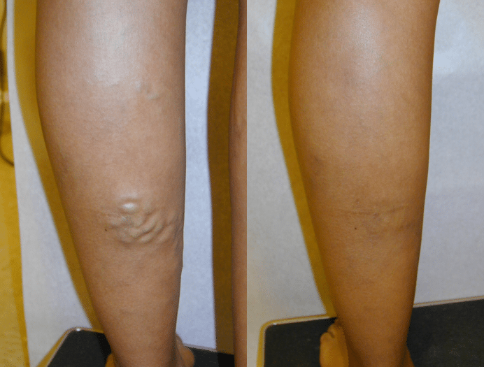 Leg 14