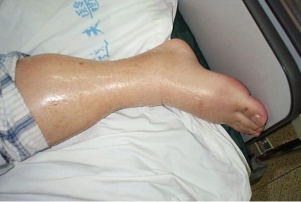 Leg Edema 02