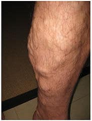 Phlebectomy of Varicose Veins