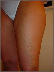 Varicose Vein Stripping