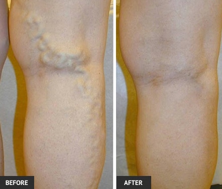 backlegveins