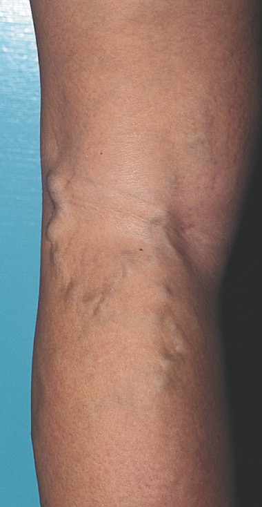 before varicoseveins sclerotherapy patient31