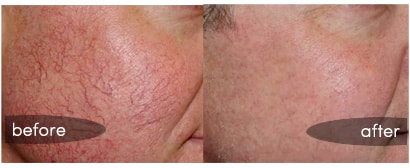 face vein treatment (1)