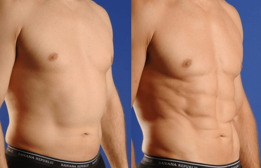 fat liposuction min